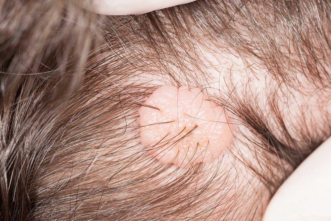 Melanocytic naevus (mole) of the scalp