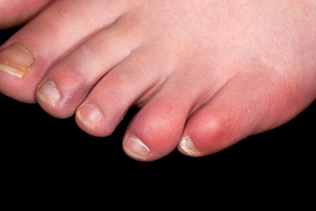 Chilblains on the toes