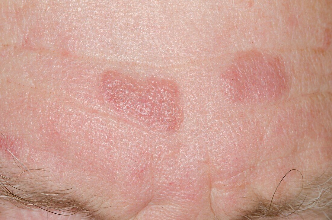 Skin plaques