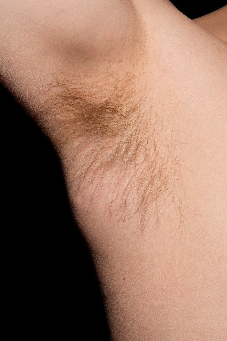 Lipoma of the armpit
