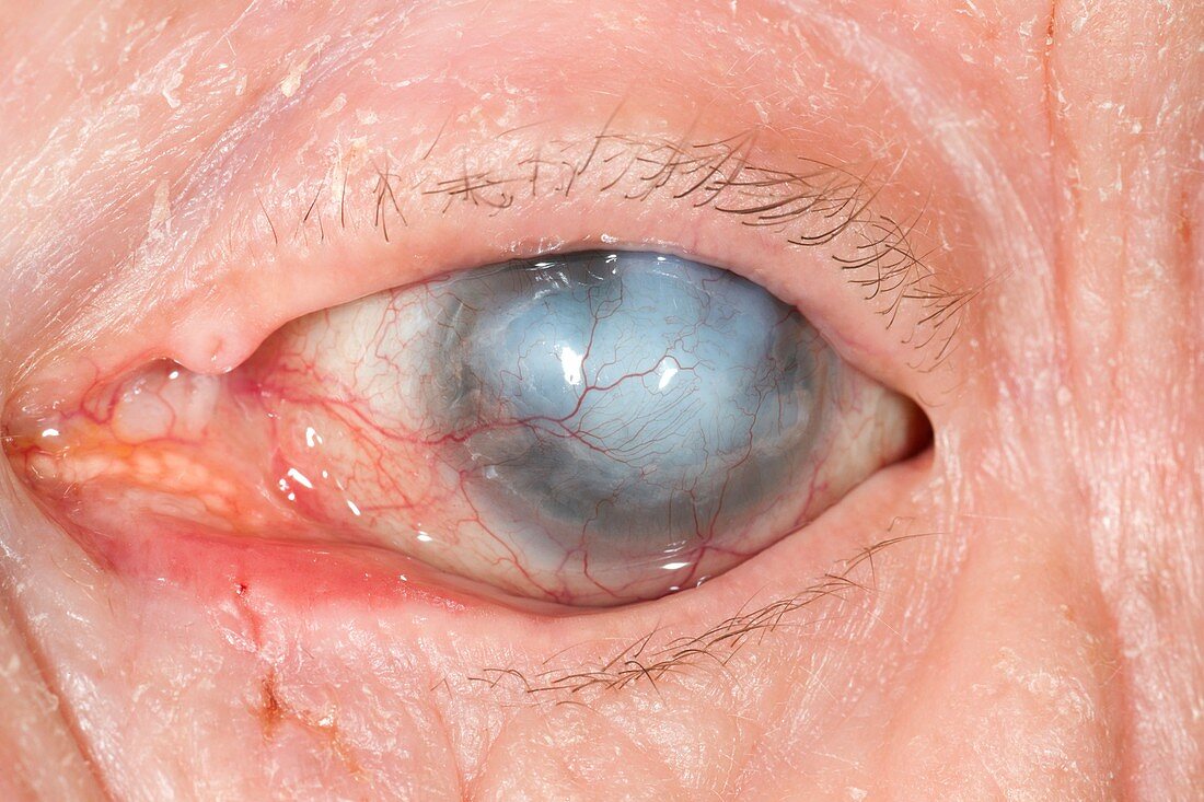 Neurotrophic ulcer in rubeotic eye