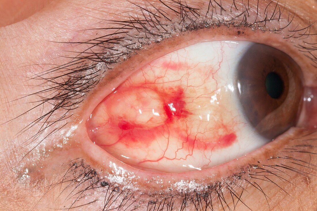 Conjunctival cyst