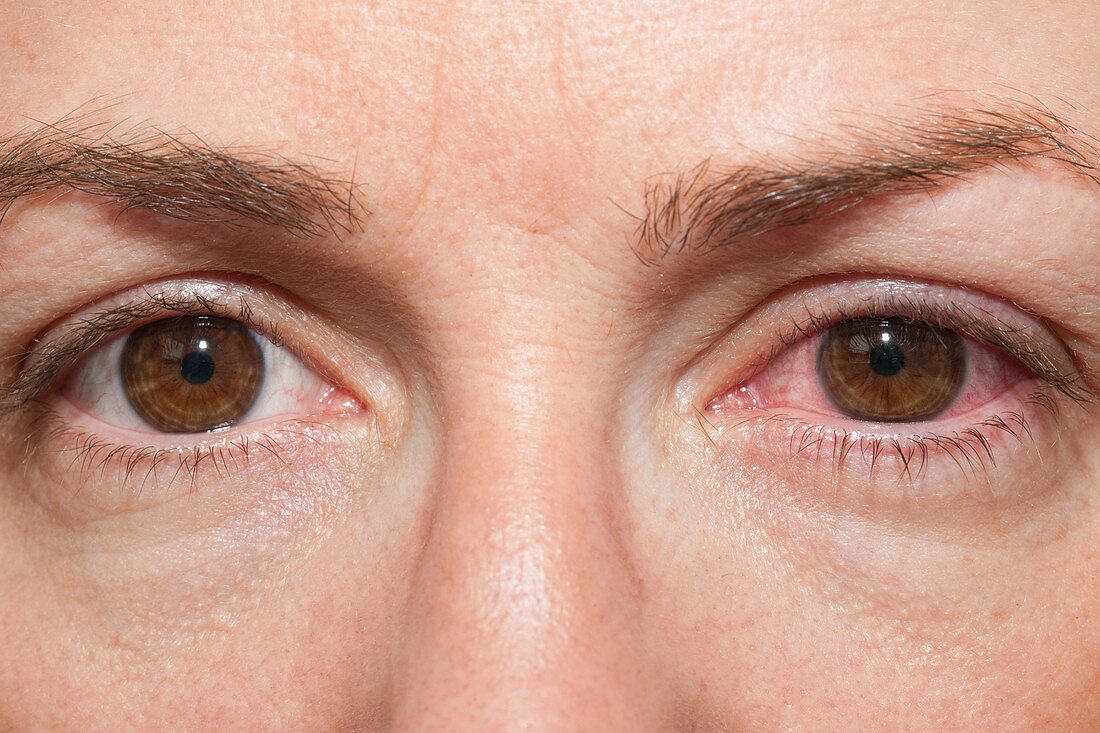 Red eye from contact lenses