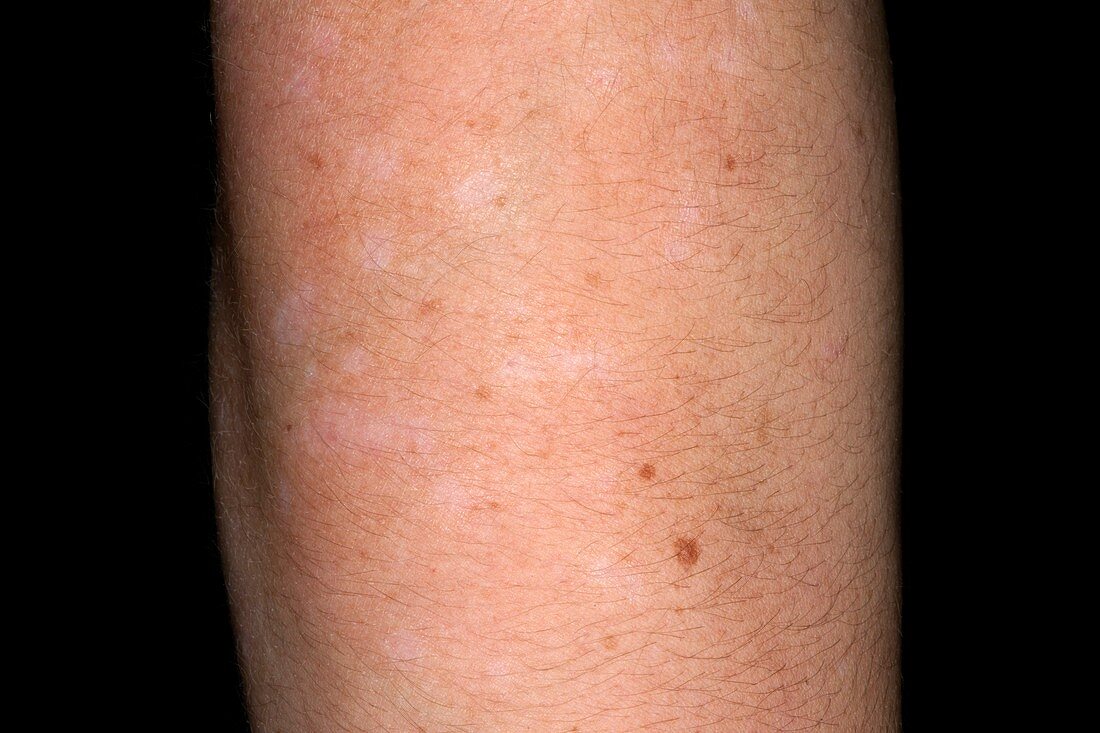 Depigmentation of skin in psoriasis