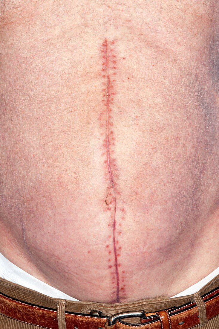 Abdominal surgical scar