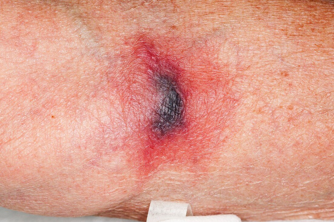 Bruised elbow pit