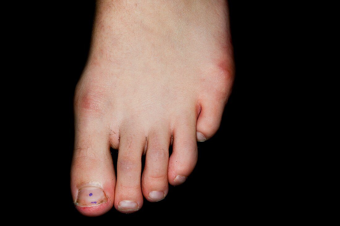 Abnormal little toe