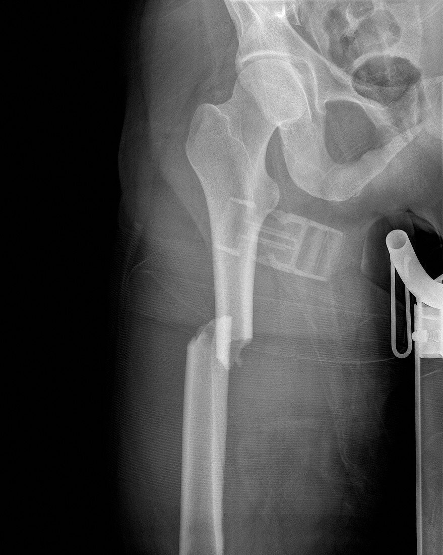 Broken femur,X-ray