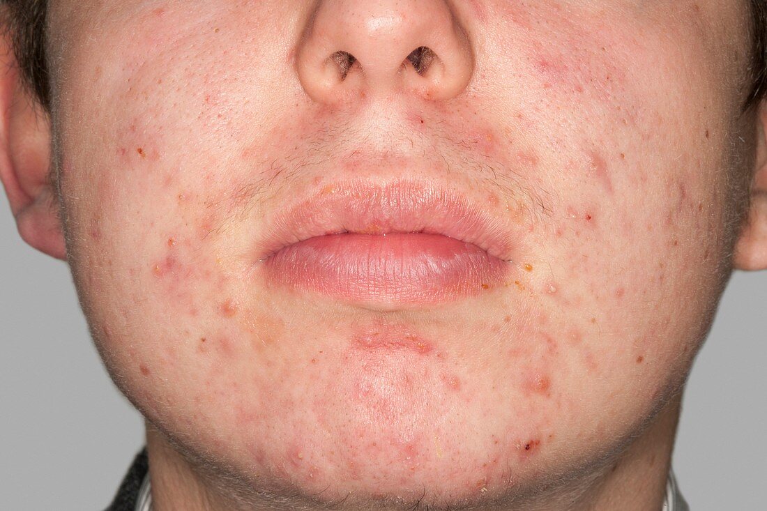 Acne vulgaris on the face