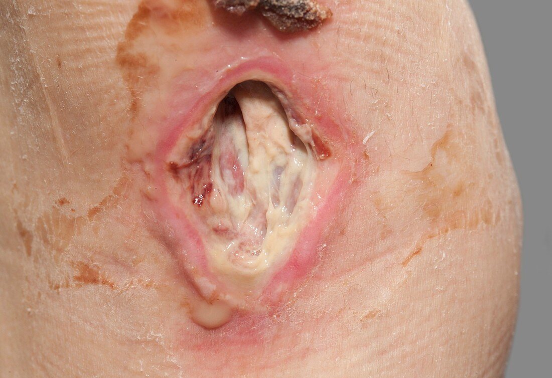 Infected ulcer