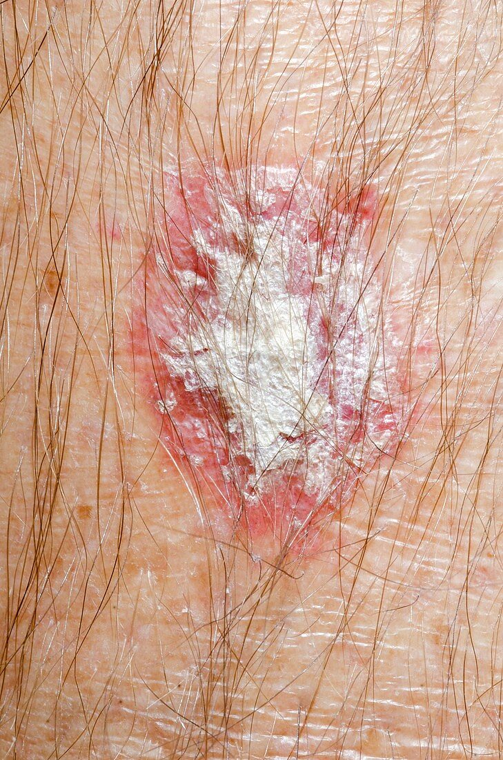 Eczema of the leg