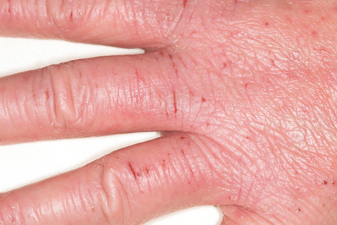 Eczema of the hand