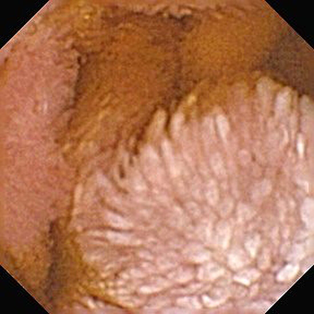 Gastrointestinal tumour,pill camera view