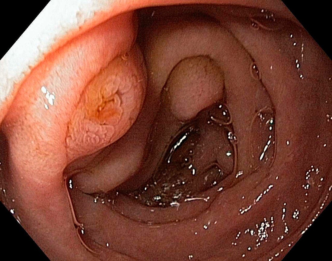 Major duodenal papilla,endoscope view