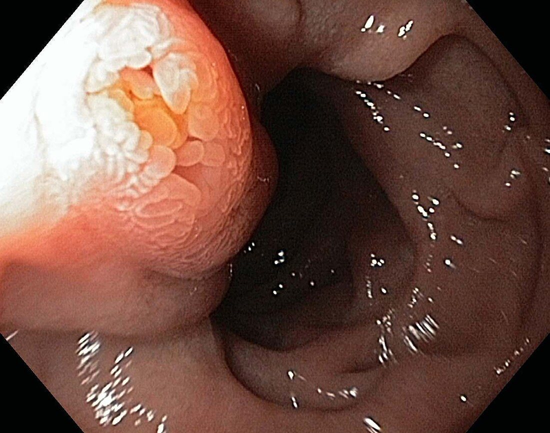 Major duodenal papilla,endoscope view