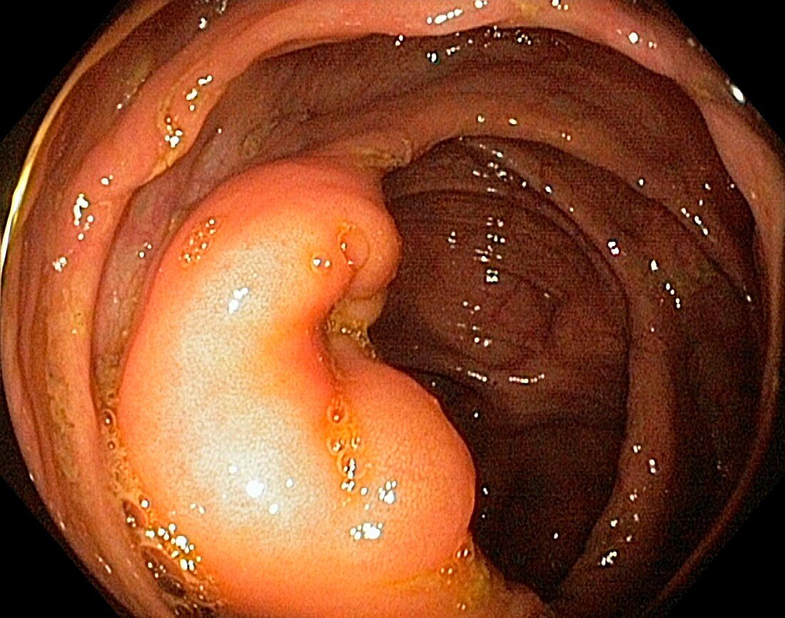 Ileocaecal valve,endoscope view