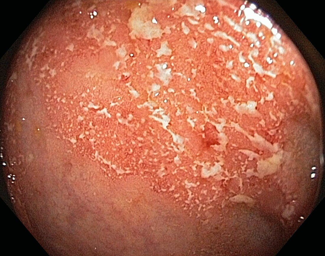 Ulcerative colitis,endoscope view