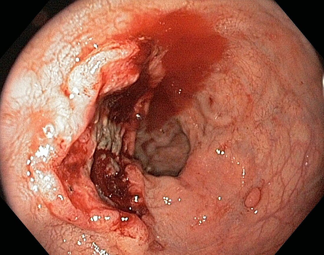 Rectal cancer,endoscope view