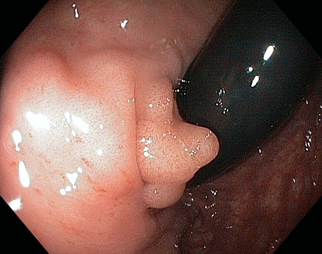 Rectal adenoma,endoscope view