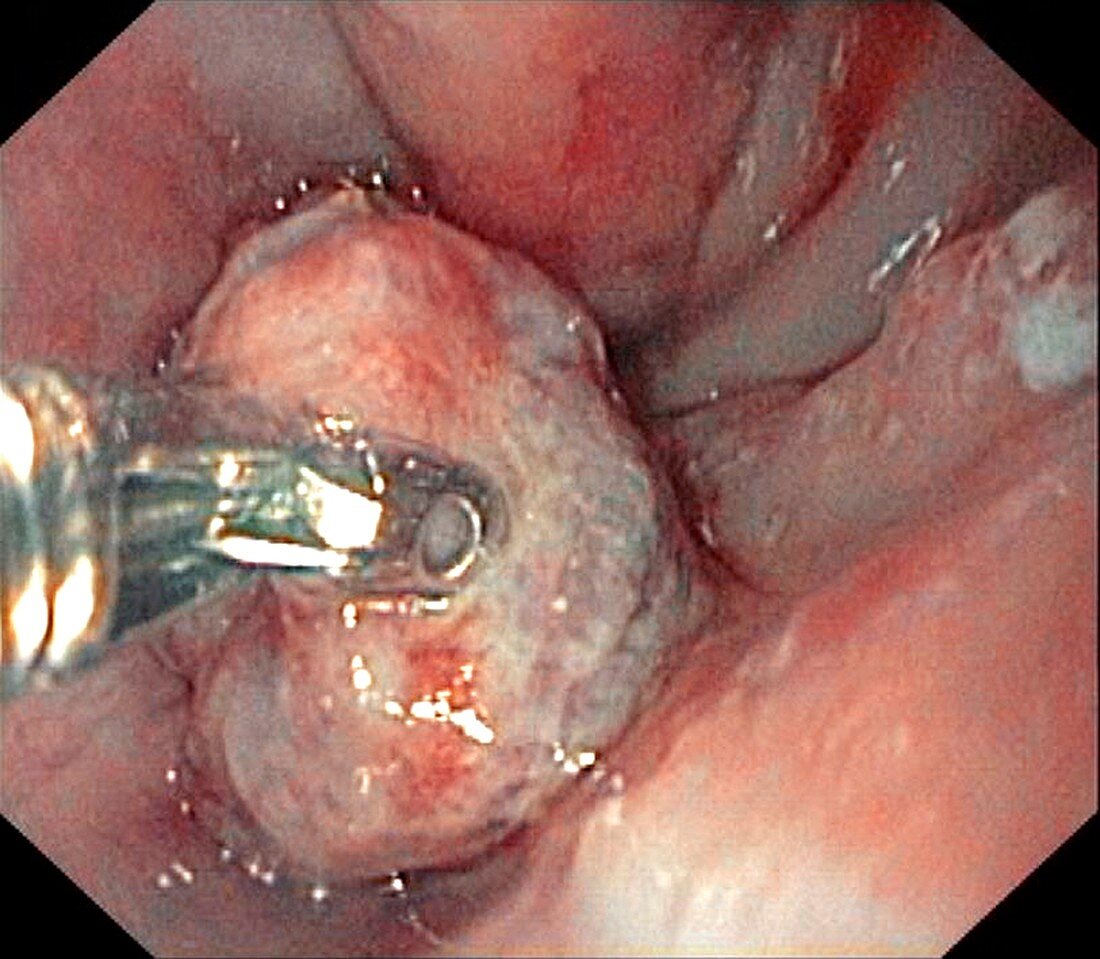 Stomach cancer,endoscope view