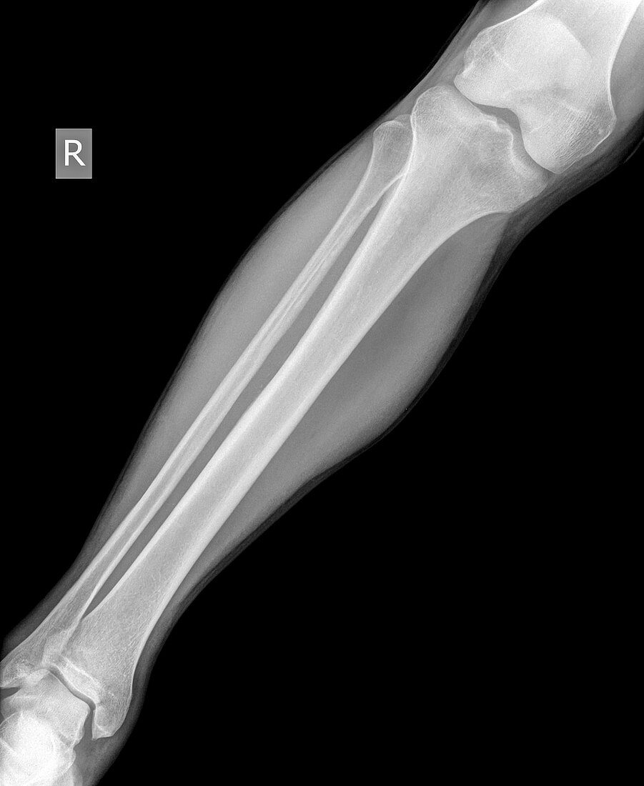 lower leg x-ray