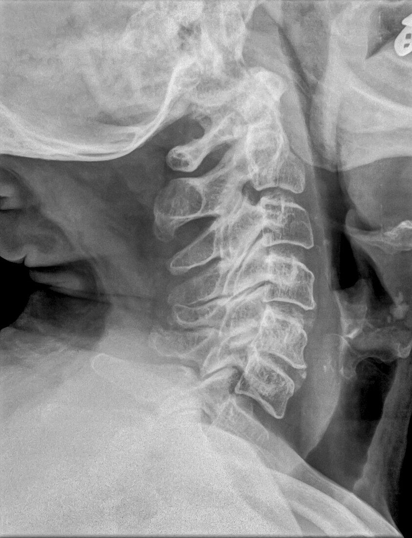 Normal Cervical spine x-ray