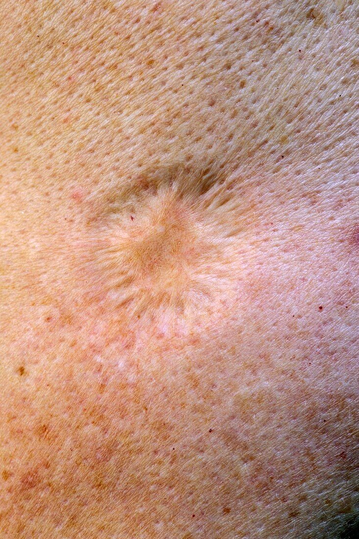 Smallpox vaccination scar
