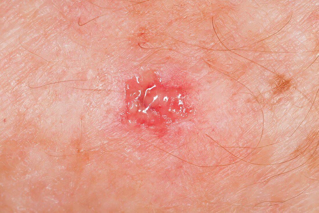 Infected tick bite