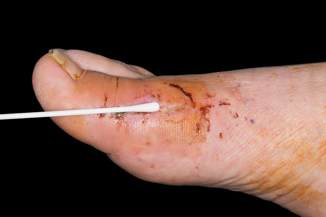 Infected wound after bone surgery