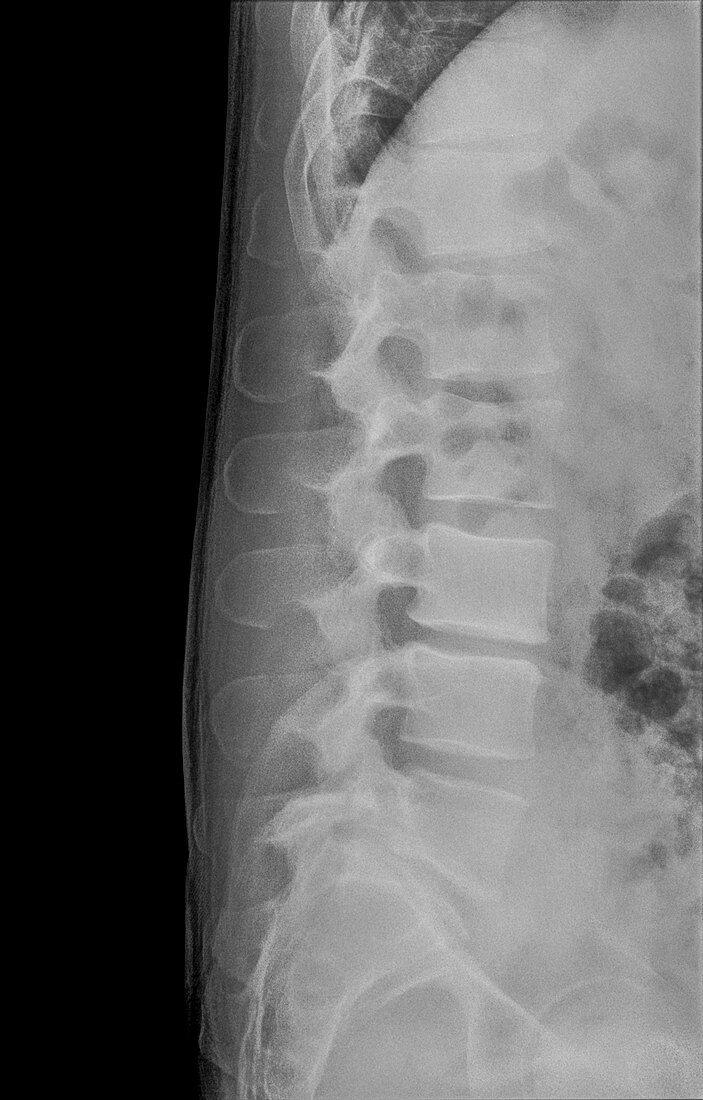 Human Lumbar Spine x-Ray