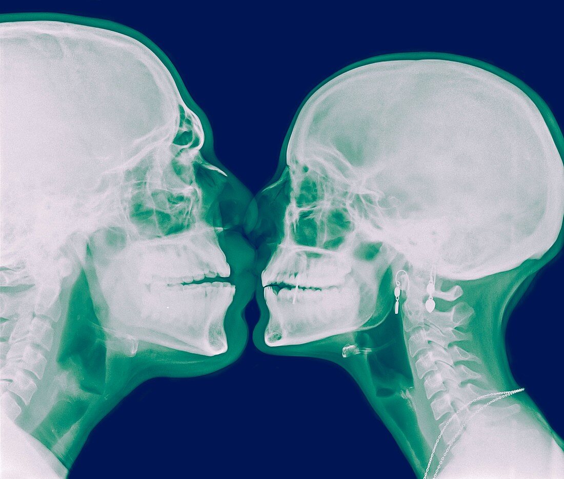 X-ray kissing