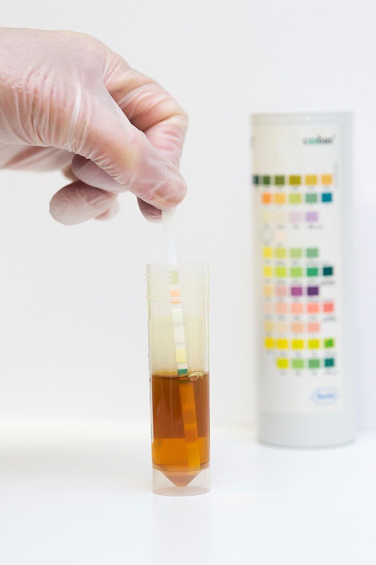 Urine test in patient with jaundice