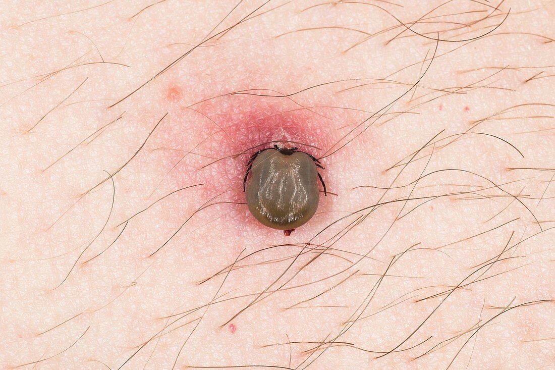 Tick feeding on a man