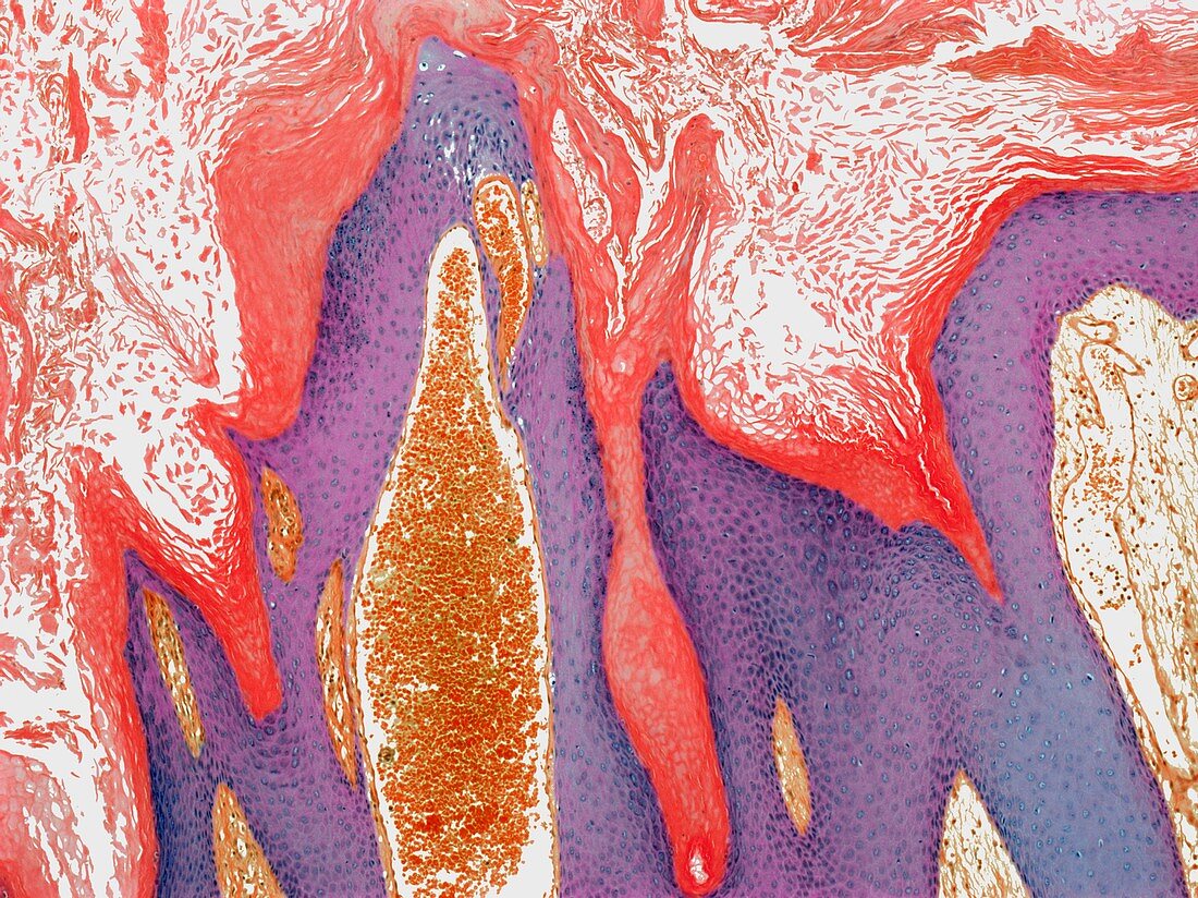 Angiokeratoma,light micrograph