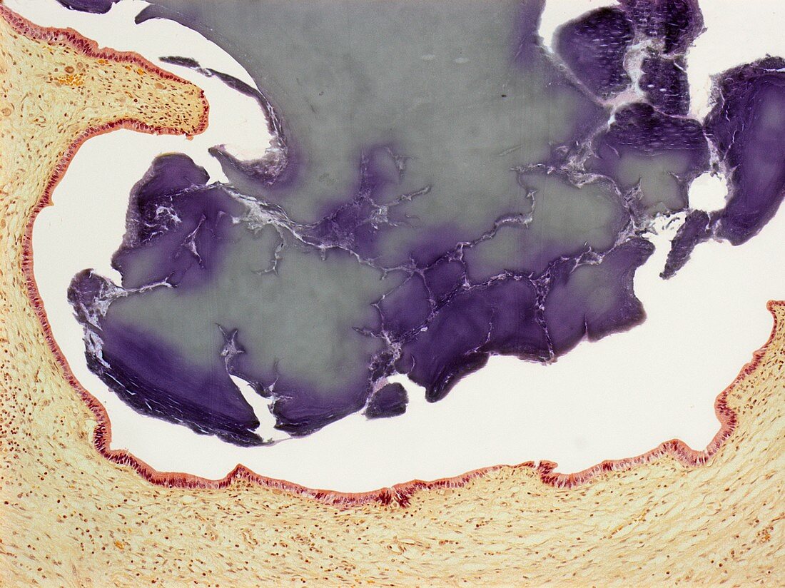 Gallstone,light micrograph