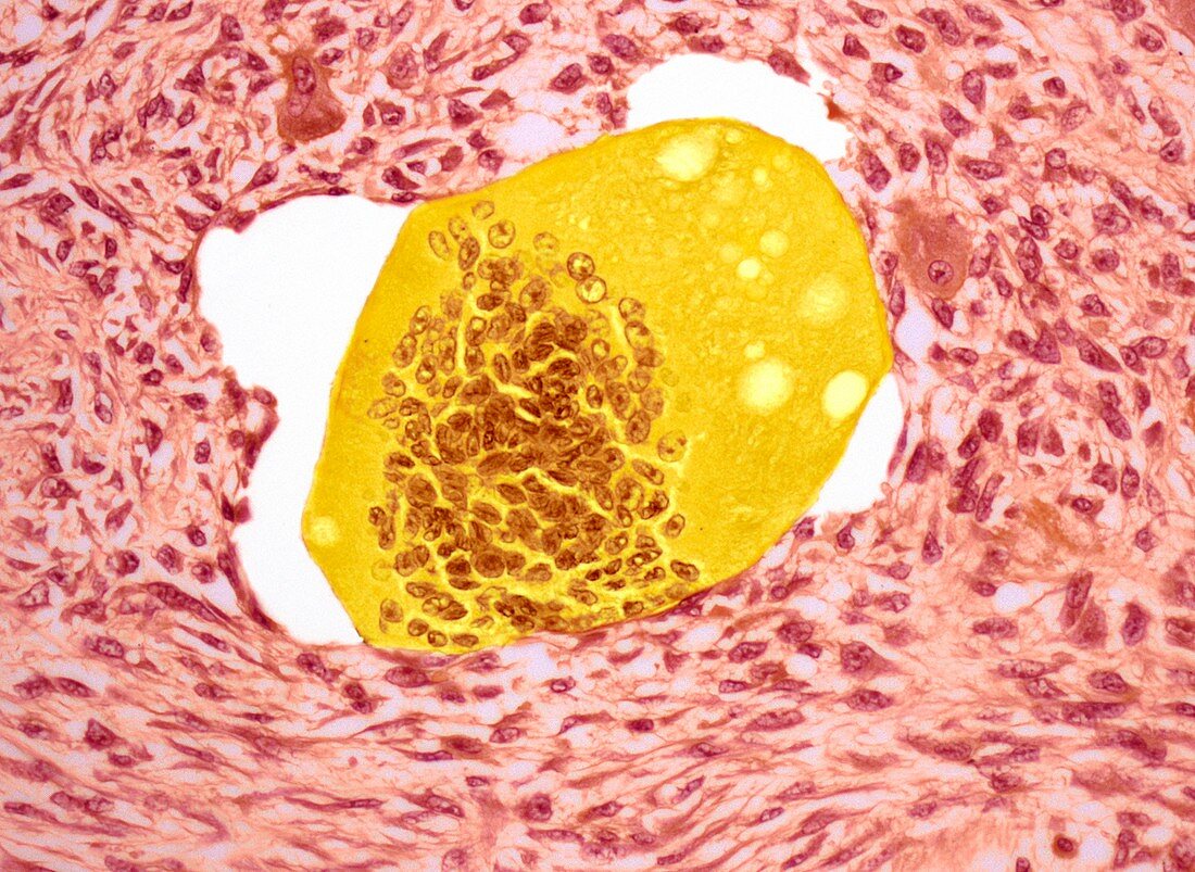 Bone tumour,light micrograph