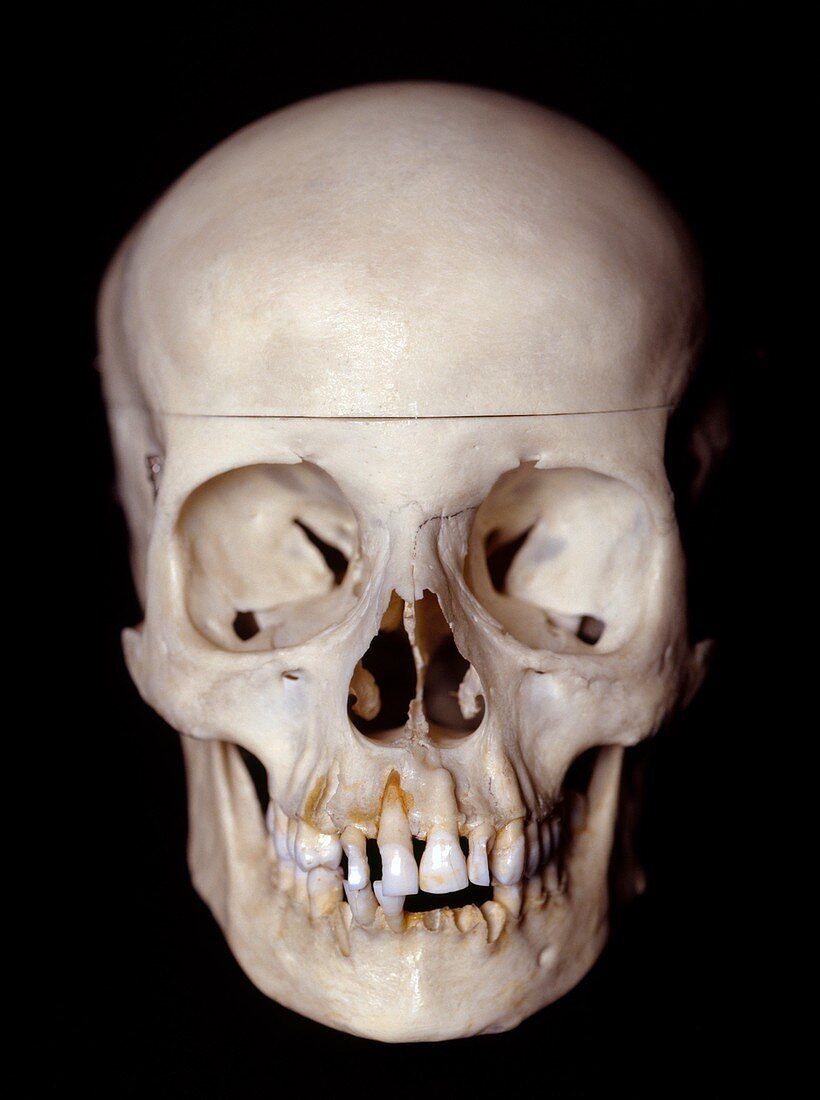 Female skull,front view