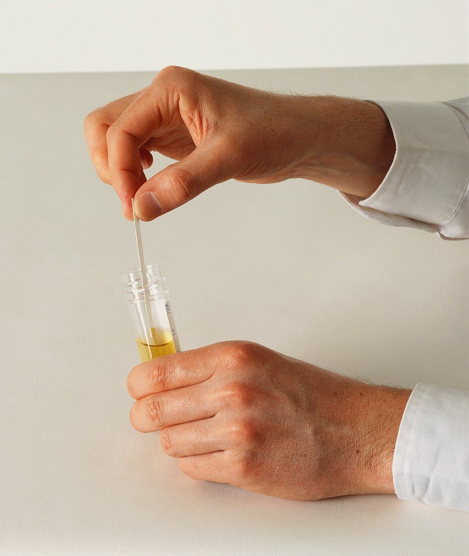 Testing strip dipped into urine specimen