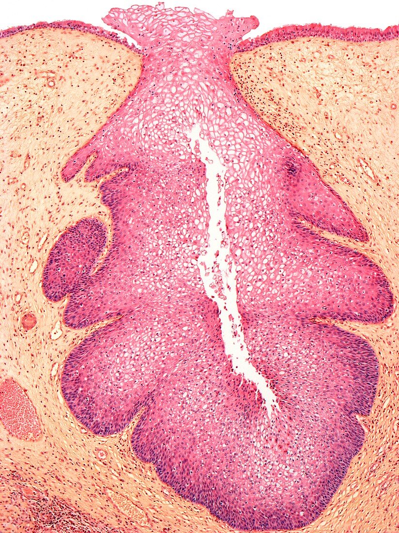 Inverted nasal papilloma