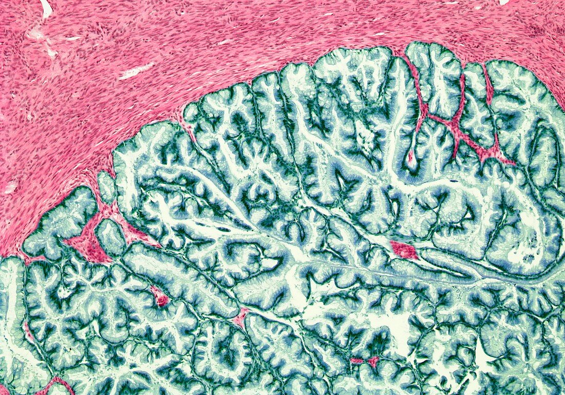 Ovarian tumour,light micrograph