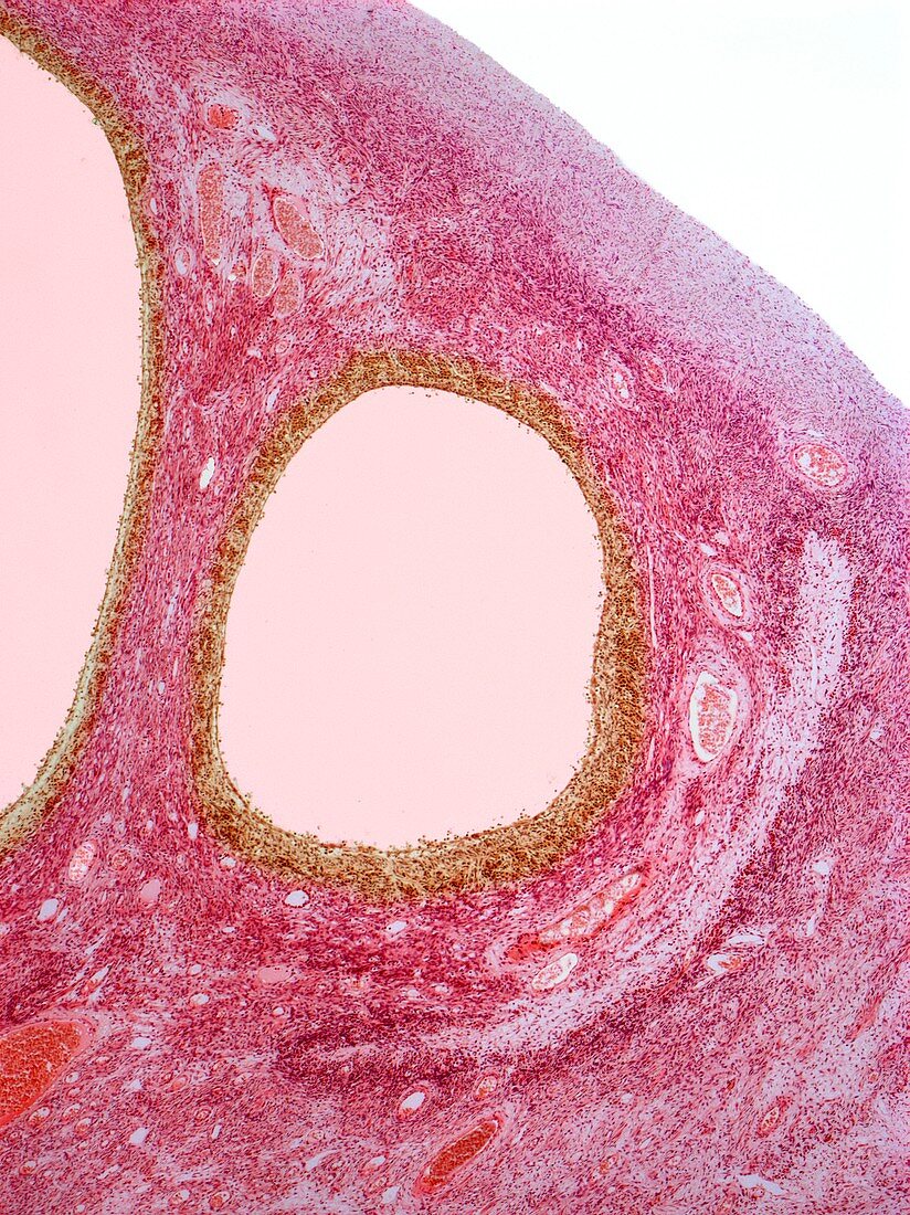 Ovarian cysts,light micrograph