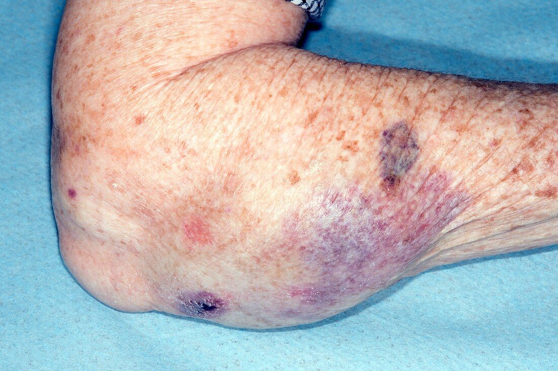 Large bruise on arm