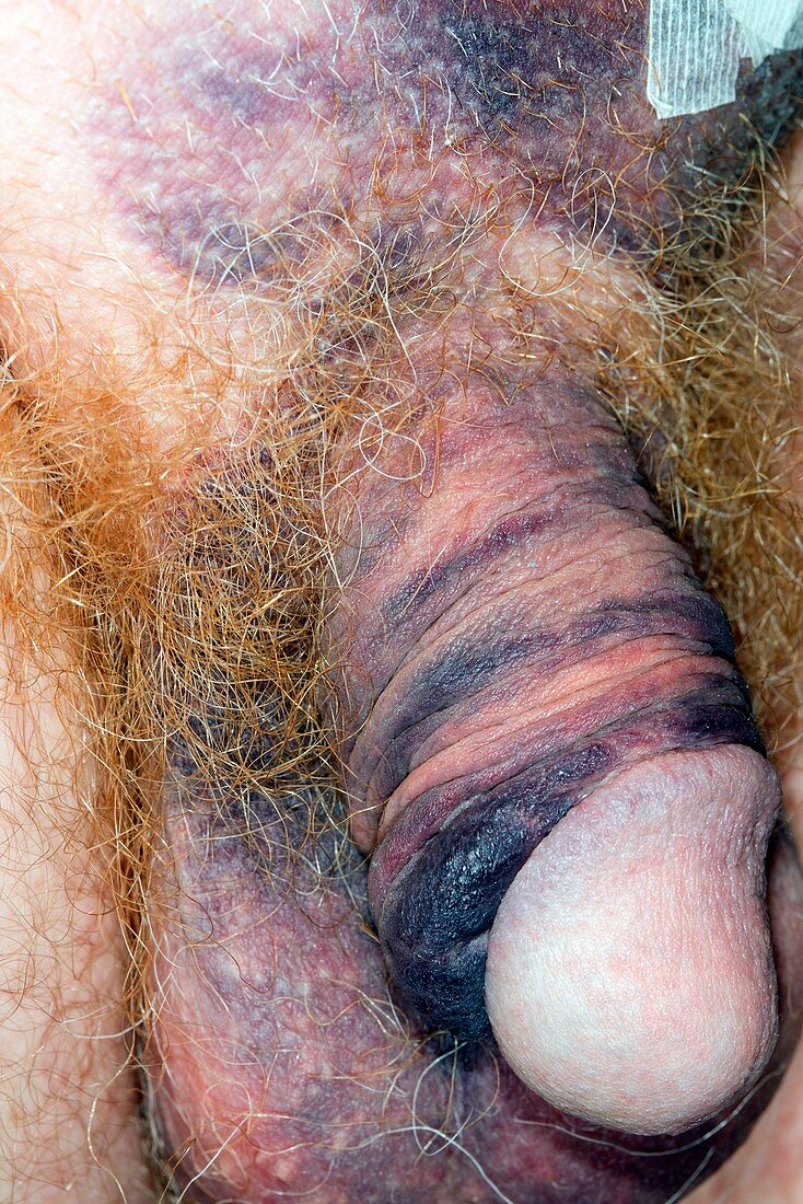 Bruising after hernia operation