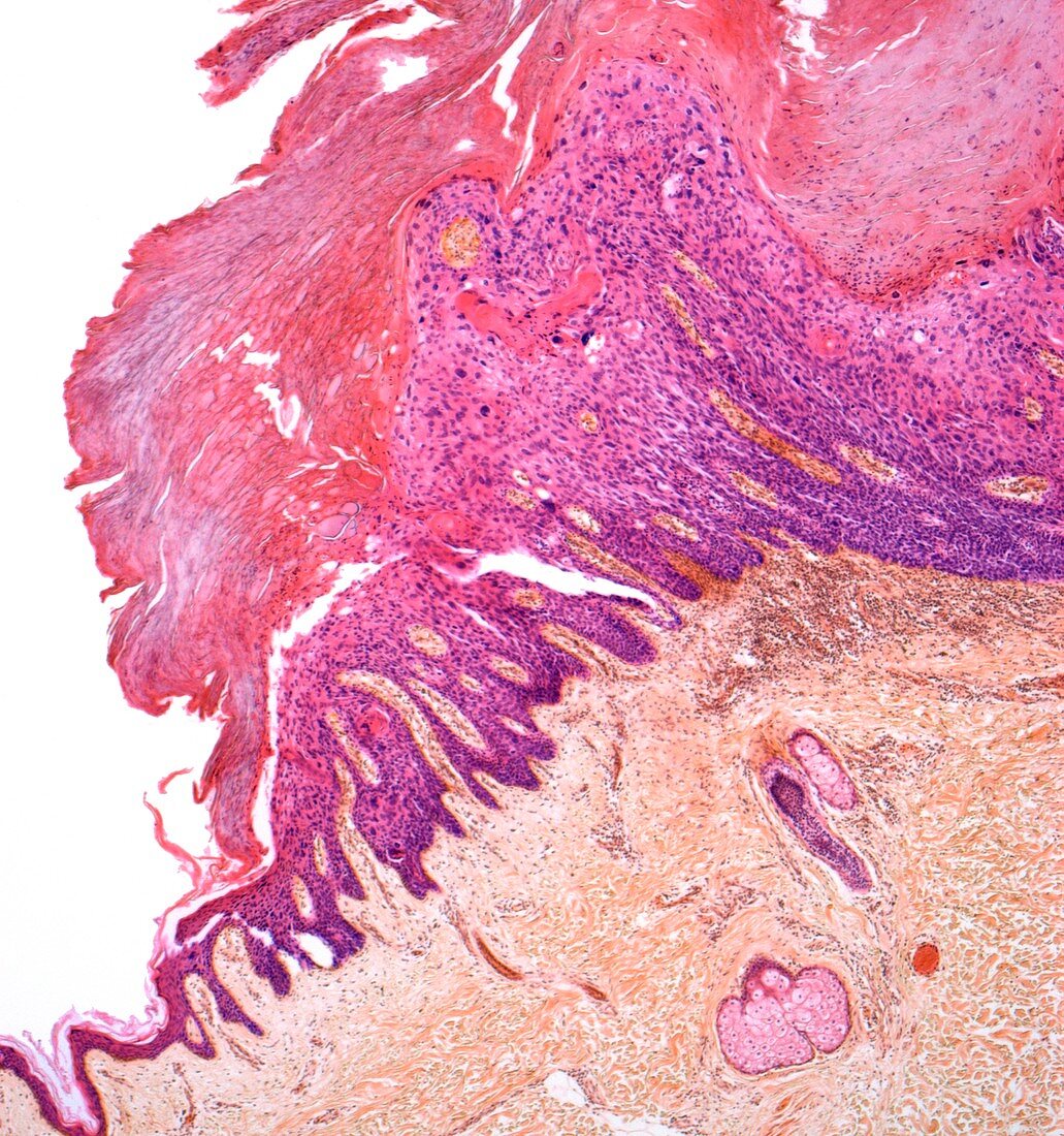 Skin cancer,light micrograph