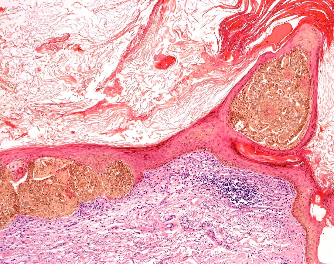 Scalp ringworm,light micrograph