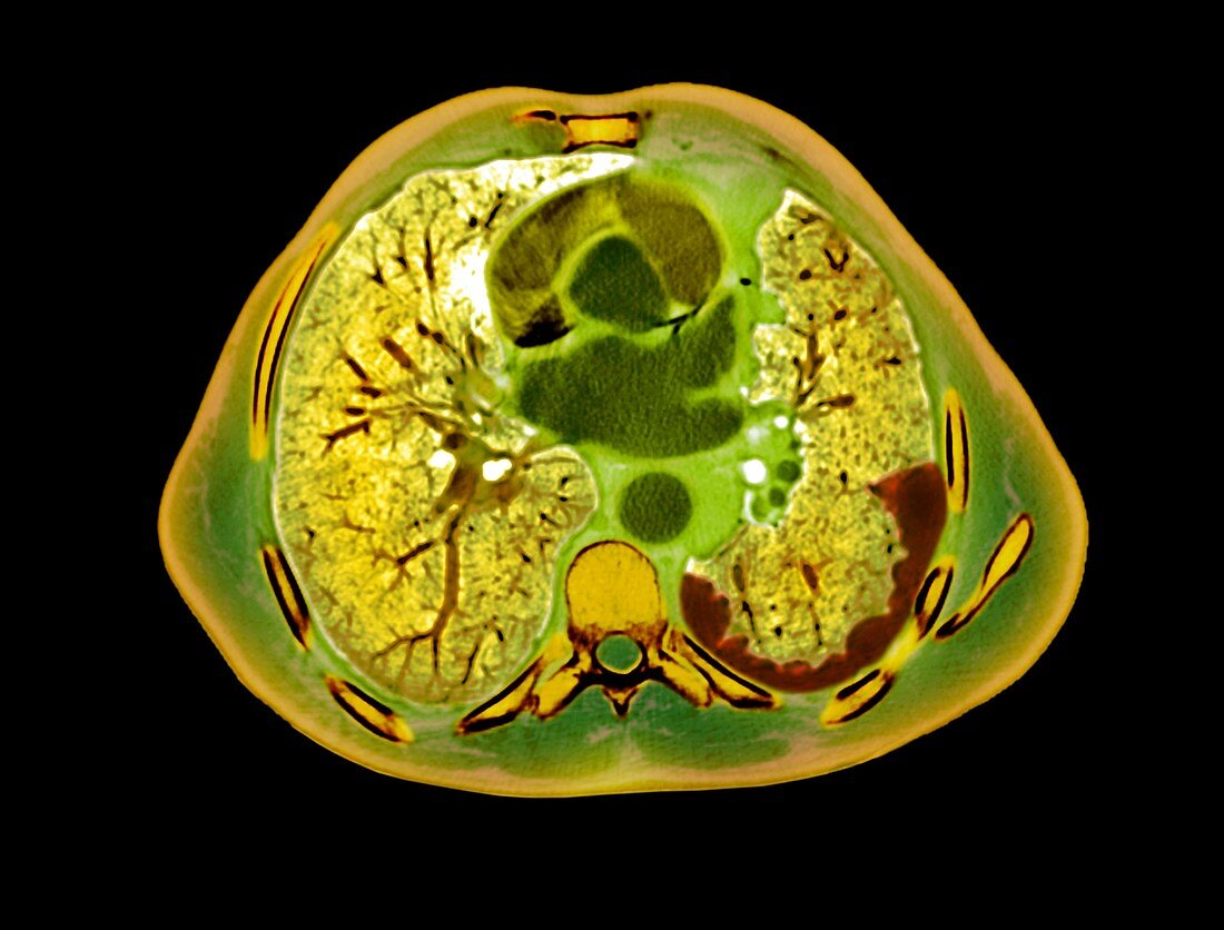 Mesothelioma lung tumour,CT scan