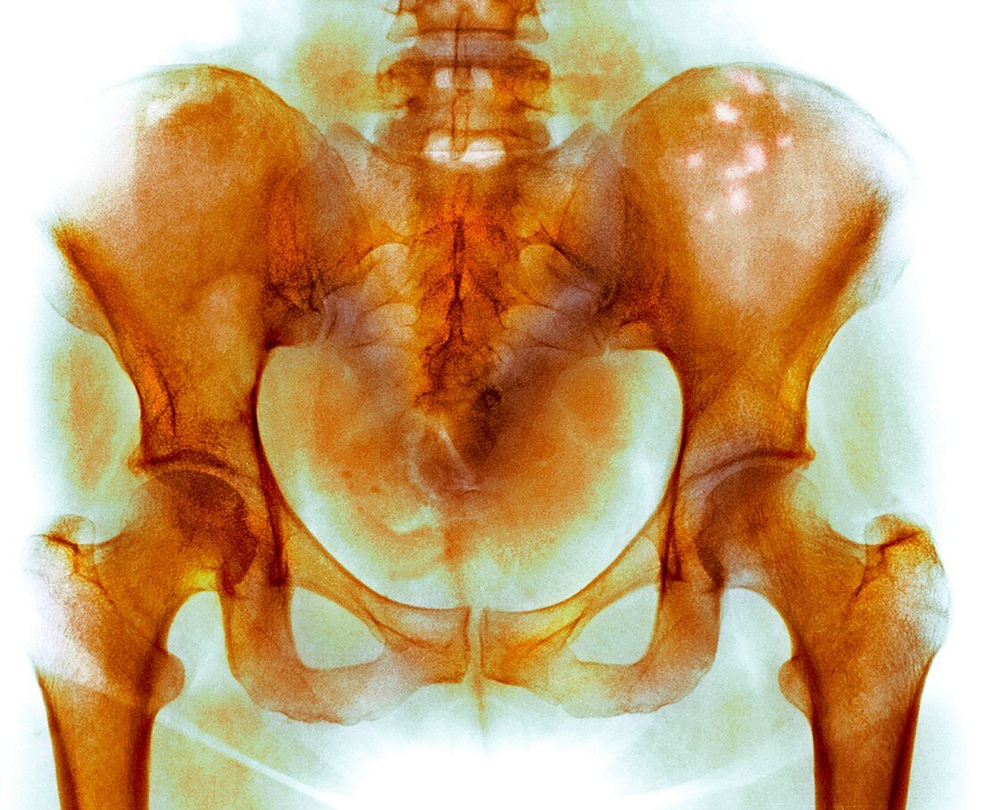 Bone marrow cancer,X-ray