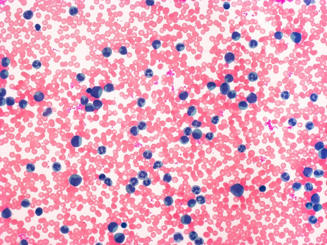 Leukaemia,light micrograph