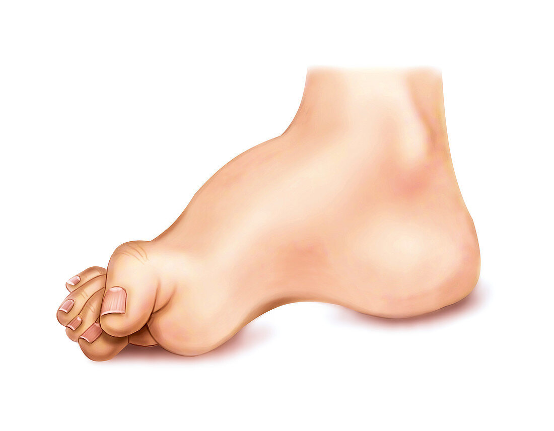 Foot deformations,artwork