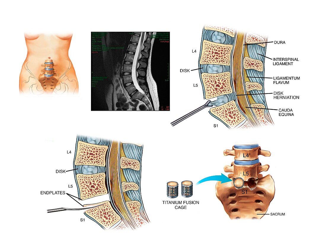 Surgery to fuse the lumbar spine